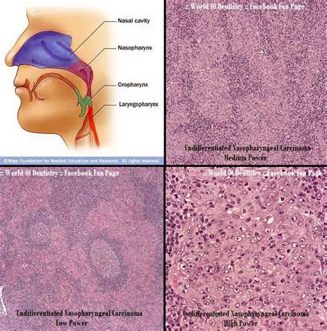 :: World Of Dentistry ::: Nasopharyngeal carcinoma