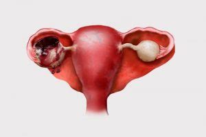 Endometrioid ovarian cyst: symptoms and treatment