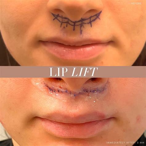 Lip Lift NYC | Lip Specialist New York
