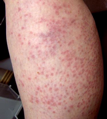 Maculopapular Rash - Pictures, Symptoms, Treatment, Causes