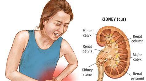 Kidney Stones