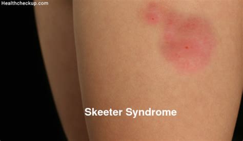 Skeeter Syndrome Treatment, Symptoms, Causes, Recovery Time