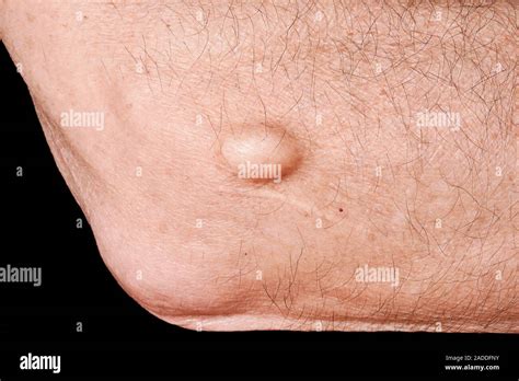 Ganglion (lump at centre) on a 70-year-old man's elbow. This is a type of cyst, named for its ...