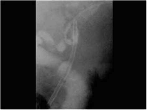 Abdomen and retroperitoneum | 1.3 Pancreas : Case 1.3.1 Pancreatic head ...