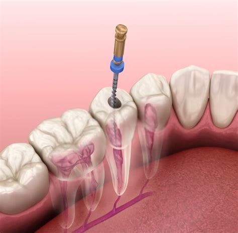 Devitalizzazione di un dente: come e perché eseguirla - Studio Dentistico Testa