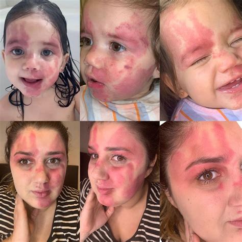 Mom uses makeup to mimic her daughter’s birthmark made of port wine in the shape of a heart ...