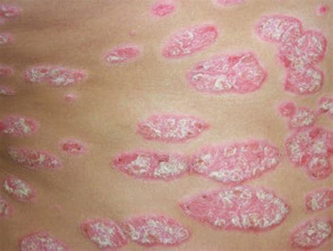 Plaque Psoriasis | Dermatology | teachIM