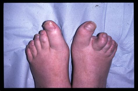 Psoriasis and psoriatic arthritis on the feet