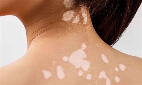 Skin discoloration causes and dark or white skin discoloration treatment