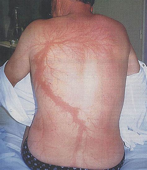 Lichtenberg Scars — Nature’s Tattoo You Don’t Want To Have | Bored Panda