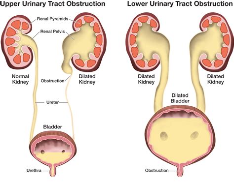 Urinary Tract Obstruction