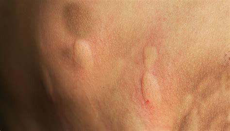 Spider Bites On Skin - vrogue.co