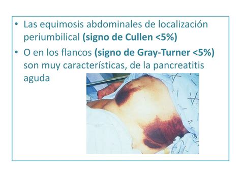 PPT - PANCREATITIS AGUDA PowerPoint Presentation, free download - ID:1150562