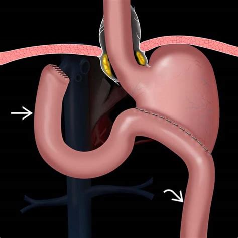 Partial Gastrectomy: Bilroth Procedures | Radiology Key