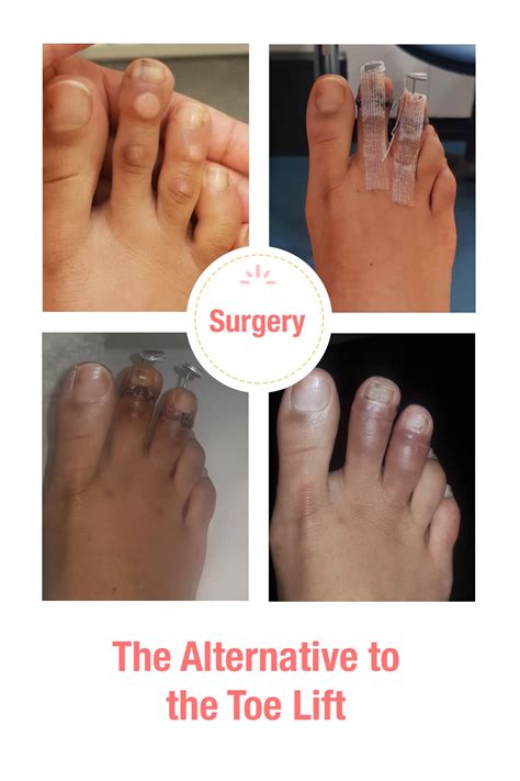 Alternative to the Toe Lift - Surgery