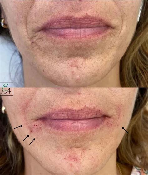How Long Does Botox Lip Flip Last? Lip Flip Procedure & Aftercare