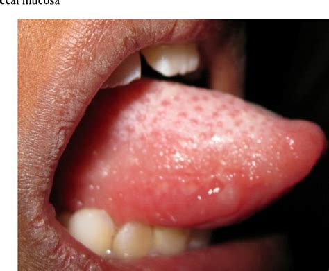 Figure 2 from Stomatitis Venenata- A Diagnostic Challenge | Semantic Scholar