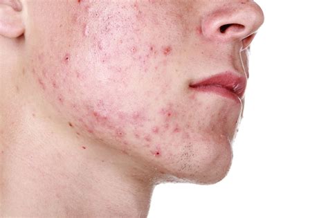 Acne nodular: tudo o que você precisa saber - Muy Salud