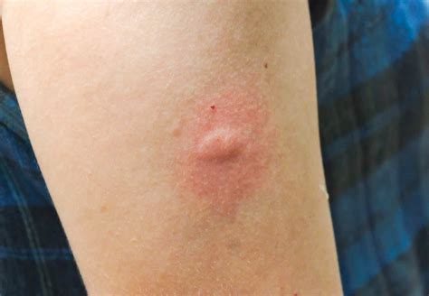 Mosquito Bite on Humans: Pictures and Tips