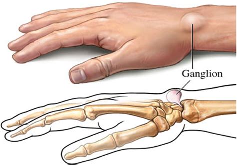 Ganglion Cyst - Causes & Management of Painful Ganglion Cysts