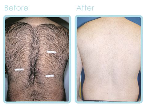 Laser Hair Removal – L. Spa | Sarasota