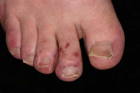 Chilblains – Comfort Feet Podiatry Group