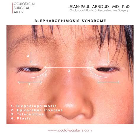 What is Blepharophimosis Syndrome?