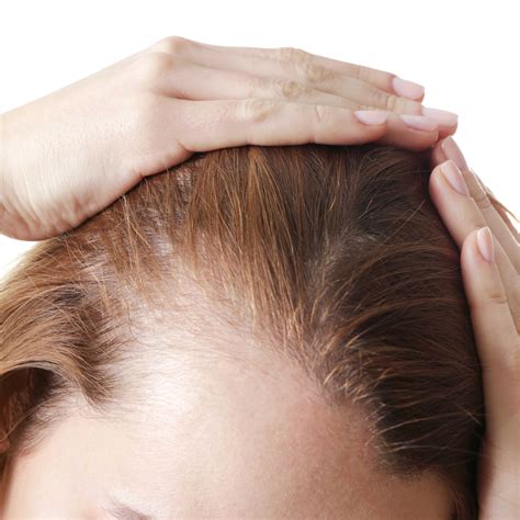 Share more than 73 female hair loss causes latest - in.eteachers