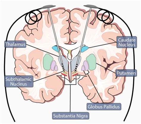 Parkinson's Disease Treatment in Miami | MNC