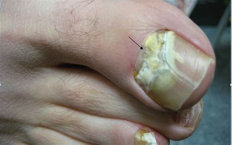 Proximal Subungual Onychomycosis