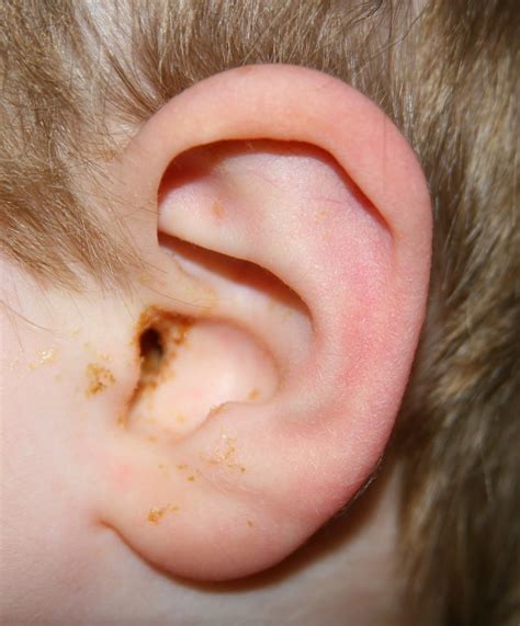 Ear Infection Child Discharge at Bobby Mueller blog