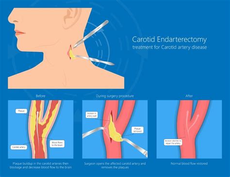 Carotid Revascularization | Brown Surgical Associates