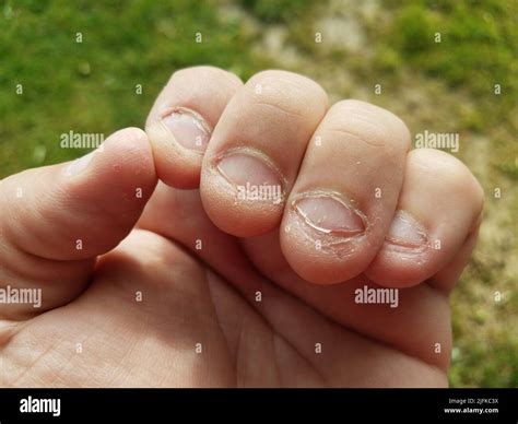 Gross fingernails hi-res stock photography and images - Alamy