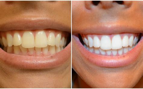 Are Teeth Whitening Strips Effective? | New Jersey Orthodontics