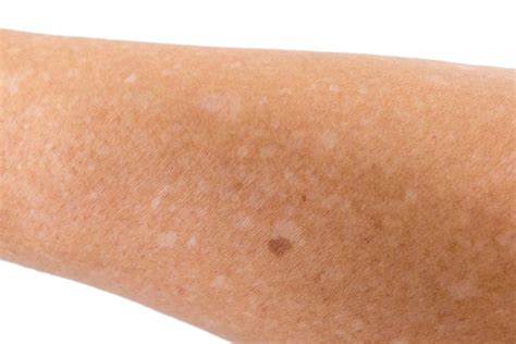 What Are the White Spots on My Skin? | Water's Edge Dermatology