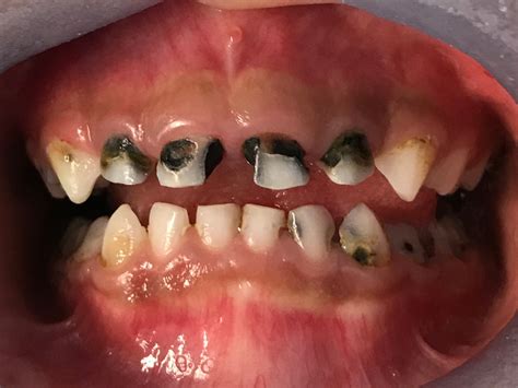 Tooth Decay In Baby Teeth Treatment - TeethWalls