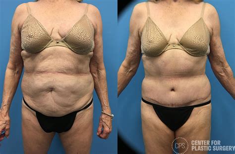 Lipo Light Body Contouring Before And After | Shelly Lighting