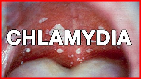 Chlamydia Discharge | www.pixshark.com - Images Galleries With A Bite!