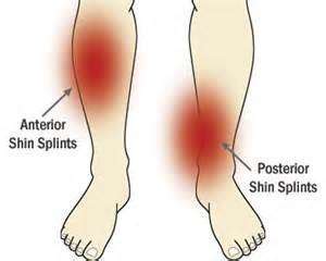 CUSTOMARY SHIN SPLINTS TREATMENT FOR RUNNERS - Muscle Pull | Muscle Pull