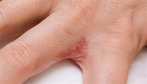 Dyshidrotic Eczema Symptoms Prevention And Treatment