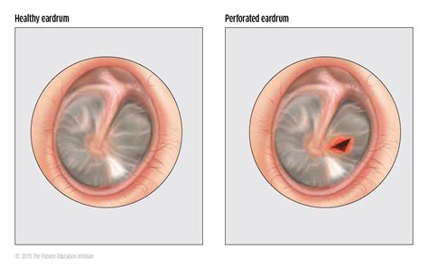 Middle ear and eardrum - HNO SARNEN EN (neu)