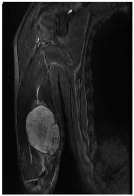 MRI scan revealed a malignant mass (size, 63x39x83 mm) in the triceps... | Download Scientific ...