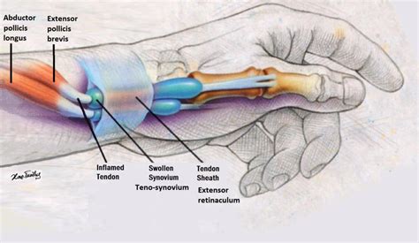 Figure_1_-_Tendons_of_the_abductor_pollicis_longus_and_extensor_pollicis_brevis_within_the ...