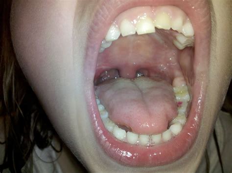 Adenoids And Tonsils Pictures