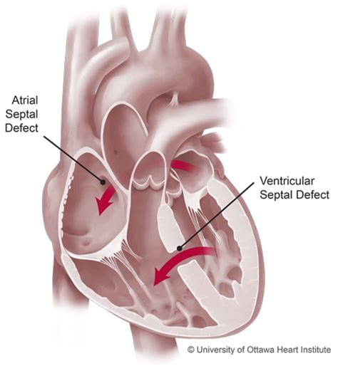 Adult Congenital Heart Defects | University of Ottawa Heart Institute