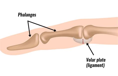 Volar plate injury - Symptoms, Causes & Treatment.