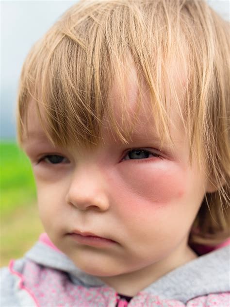 Anaphylaxis (Pediatric) Signs And Symptoms | MIMS Malaysia