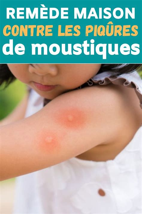 Remède maison contre les piqûres de moustiques | Piqure de moustique ...