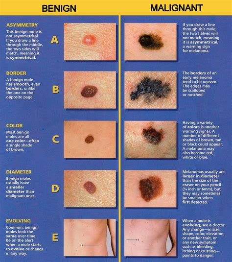 Melanoma: How do you know if a mole is dangerous? - Carenity