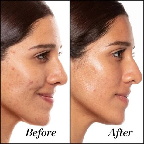 Retinol Before and After: Transform Your Skin with These Results - Must Read This Before Buying